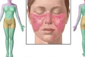 Atenţie la lupus! Este boala care imită alte boli! 