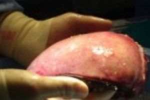 Numarul donatorilor de rogane a scazut dramatic / Ziua donatorului de organe a fost sarbatorita ieri