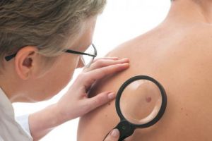 Peste 230 de pacienţi s-au prezentat la medic în cadrul campaniei de depistare a cancerului de piele