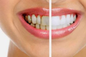 Primele semne ale paradontozei. Asa recunosti boala, înainte să te lase fără dinti 