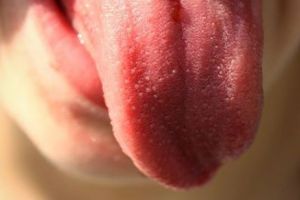 Cancerul limbii- Simptome si tratament 