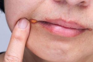 Remedii naturale pentru a trata şi preveni stomatita angulară 