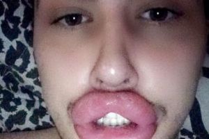 Nu vă speriaţi! Bărbatul şi-a INJECTAT buzele cu BOTOX  atât de mult încât compoziţia a început să tâşnească pe dinafară. FOTO în articol