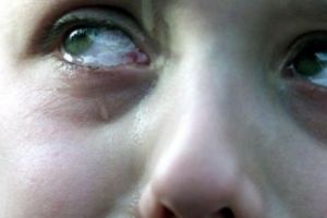 ALERTĂ. Focar de hepatită A la copii, în ALBA. Sursa probabilă: APA! 