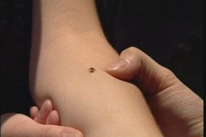 Caz de boala Lyme in Timis. Peste 140 de pacienti au venit la spital muscati de capuse, intr-o luna