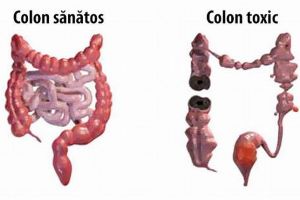 „Colonul omului este groapa de gunoi a organismului. 90 % din boli de aici provin.”