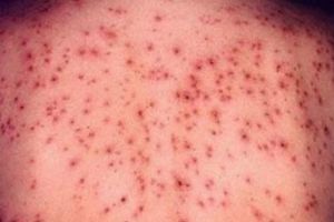 Încă 12 cazuri de rujeolă, confirmate în ultima săptămână