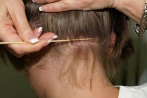 A crescut numarul de imbolnaviri cu paduchi in randul prescolarilor si scolarilor. Ce a transmis DSP Constanta