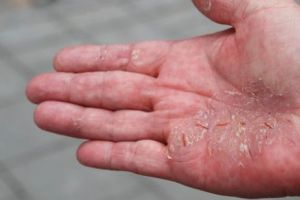 Ai atins un BOLNAV DE PSORIAZIS? ATENȚIE! Medicii îţi dau o veste IMPORTANTĂ! 