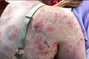 SOLUȚIE DISPERATĂ. O mamă şi-a salvat fiica cu propriul trup