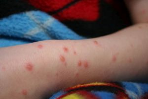 Încă 16 cazuri de rujeolă,  confirmate în ultima săptămână