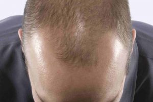 Vă cade părul? Iată ce leacuri recomandă farm. dr. Ovidiu Bojor