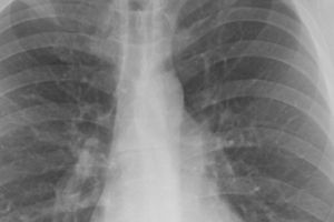 Gestul banal pe care îl fac mulţi oameni poate provoca pneumonie