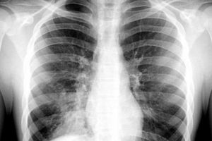 ATENȚIE părinţi! Gestul BANAL care poate aduce PNEUMONIE în mod special copiilor