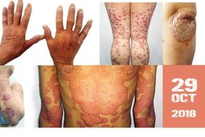 Peste 2% din populaţia României suferă de psoriazis