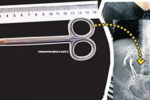 Directorul medical al Spitalului Militar din Constanţa a uitat două foarfeci de 16 cm în burta unei paciente de 61 de ani!