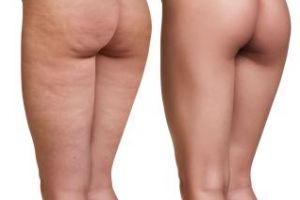 Renunţă la aceste alimente şi scapi de celulită