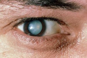 Unu din doi oameni de peste 60 de ani, afectat de cataractă