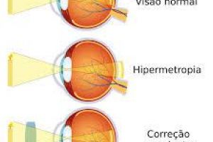Hipermetropia: cauze, diagnostic şi tratament