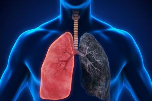 Tu ştii câţi ani au plămânii tăi?  BPOC – diagnostic şi tratament