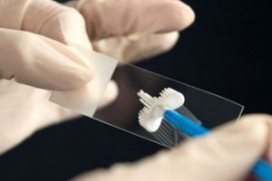 Cancerul de col uterin