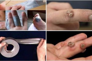 Remedii bizare care chiar vindecă