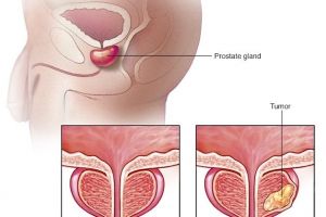 Cancerul de prostată – diagnostic şi tratament