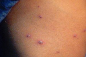 Focar de varicelă la Târgu-Cărbuneşti