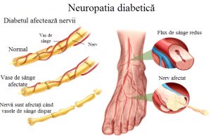 Diabetul zaharat, pericol major pentru sănătatea picioarelor