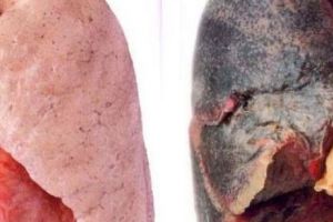 Povestea primului transplant pulmonar