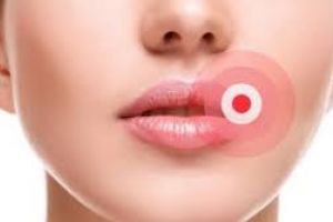 Cum să scapi de herpes simplu şi rapid