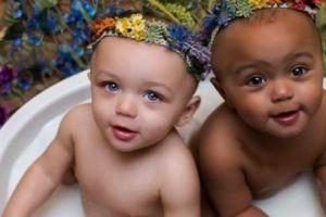 Şocant. Singurele gemene din lume care au culoarea pielii diferită
