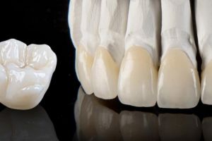 Care varianta este mai buna dintre coroana metalo-ceramica si coroana din zirconiu?