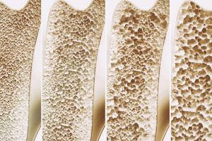 Sfatul medicului OSTEOPOROZA – ce trebuie să ştii