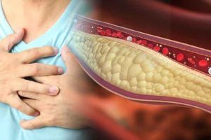 Efectele hipercolesterolemiei asupra organismului