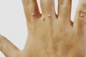 Negii sau verucile – diagnostic şi tratament