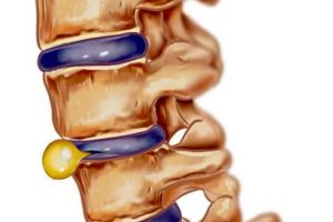 Hernia de disc – cauze şi simptome