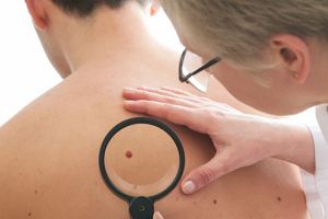 Zeci de hunedoreni diagnosticaţi cu cancer de piele