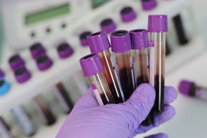 Mononucleoza sau boala sărutului – Diagnostic, complicaţii, tratament