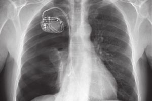 Pneumotoraxul – simptomatologie