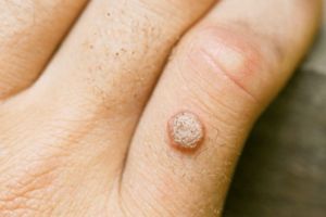 Negii: 6 răspunsuri de la medicii dermatologi la întrebările frecvente