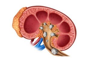Litiaza renală – definiţie, simptomatologie, prevenţie