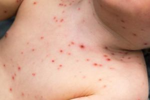 DSP Bihor despre epidemia de rujeolă: În acest an, s-au înregistrat 83 de cazuri, majoritatea la copii romi