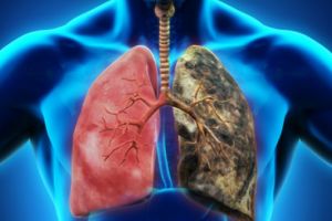 Cancerul pulmonar, cea mai agresivă formă de cancer