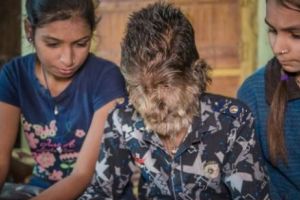 Acest băiat suferă de sindromul VÂRCOLAC. Atenţie!  VIDEO extrem de emoţionant în articol
