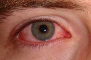 Sindromul Sjögren – diagnostic şi tratament