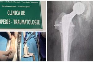 Transplant osos la Timişoara în cazul pacienţilor cu afecţiuni ale aparatului locomotor
