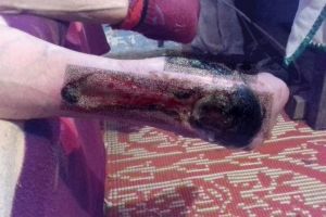 Asistenţii comunitari din Albeni, din neştiinţă, fac pe doctorii! Ei tratează, la domiciliu, piciorul cangrenat al unui localnic