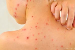 O nouă epidemie în România! 61 de persoane au murit din cauza rujeolei. Zeci de îmbolnăviri în ultima săptămână