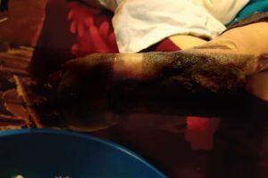 Bolnava fotografiată cu piciorul cangrenat a decedat! Primăria Albeni şi DSP Gorj o anchetează  pe asistenta medicală comunitară, care şi-a încălcat atribuţiile de serviciu